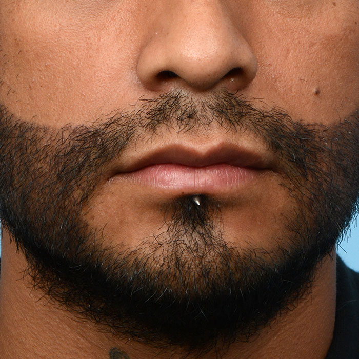 Facial Hair Beard Before and After | Dr. Jeffrey Wise