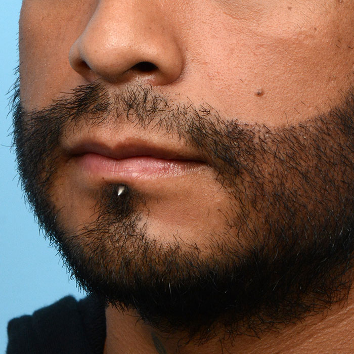 Facial Hair Beard Before and After | Dr. Jeffrey Wise