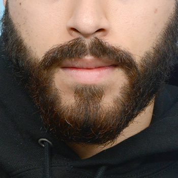 Facial Hair Beard Before & After 4