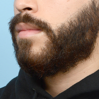 Facial Hair Beard Before and After | Dr. Jeffrey Wise