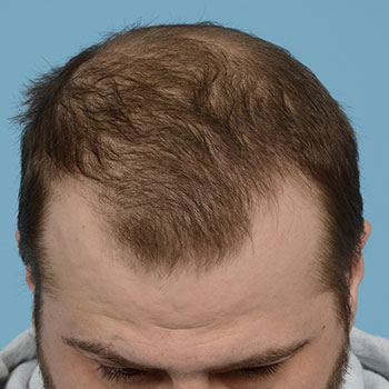 Fue Before and After | Dr. Jeffrey Wise