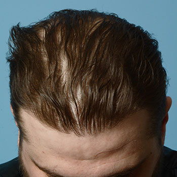 Fue Before and After | Dr. Jeffrey Wise