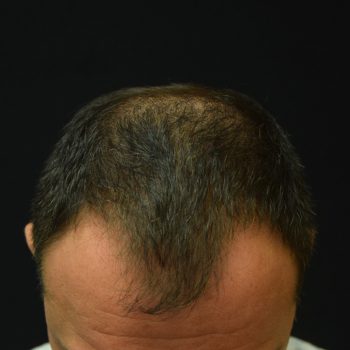 Fue Before and After | Dr. Jeffrey Wise