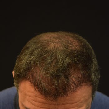 Fue Before and After | Dr. Jeffrey Wise