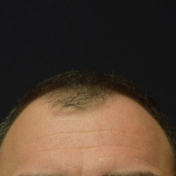 Fue Before and After | Dr. Jeffrey Wise