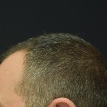 Fue Before and After | Dr. Jeffrey Wise