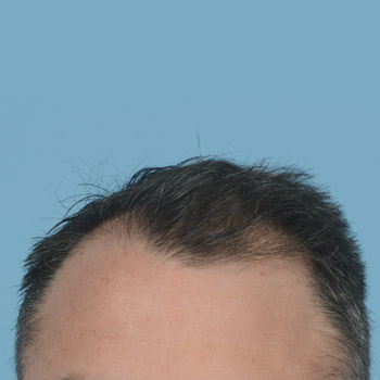 Fue Before and After | Dr. Jeffrey Wise