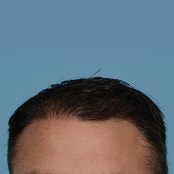 Fue Before and After | Dr. Jeffrey Wise