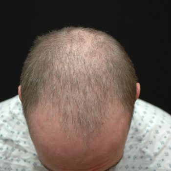 Fue Before and After | Dr. Jeffrey Wise