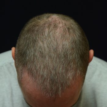 Fue Before and After | Dr. Jeffrey Wise