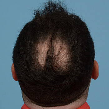 Fue Before and After | Dr. Jeffrey Wise