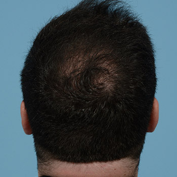 Fue Before and After | Dr. Jeffrey Wise