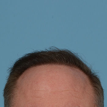 Fue Before and After | Dr. Jeffrey Wise