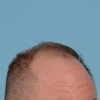 Fue Before and After | Dr. Jeffrey Wise