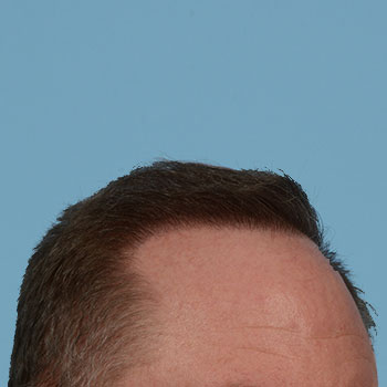 Fue Before and After | Dr. Jeffrey Wise