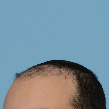 Fue Before and After | Dr. Jeffrey Wise