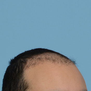 Fue Before and After | Dr. Jeffrey Wise