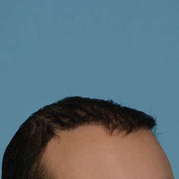 Fue Before and After | Dr. Jeffrey Wise