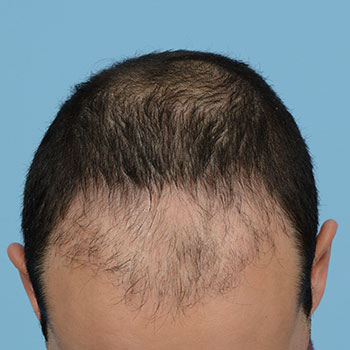 Fue Before and After | Dr. Jeffrey Wise