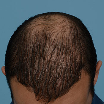 Fue Before and After | Dr. Jeffrey Wise