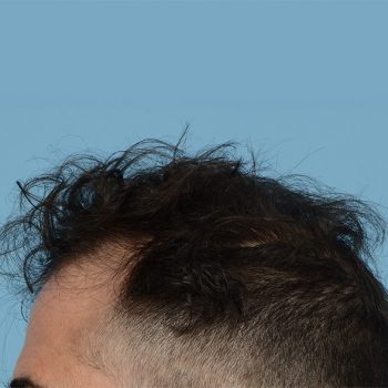 Fue Before and After | Dr. Jeffrey Wise