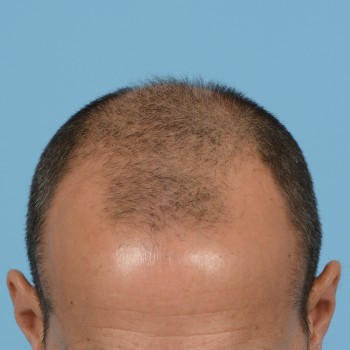 Fue Before and After | Dr. Jeffrey Wise