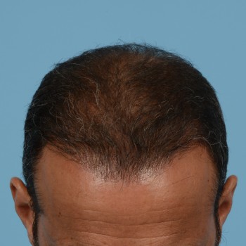 Fue Before and After | Dr. Jeffrey Wise