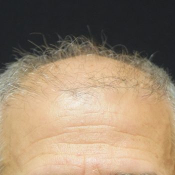 Fue Before and After | Dr. Jeffrey Wise