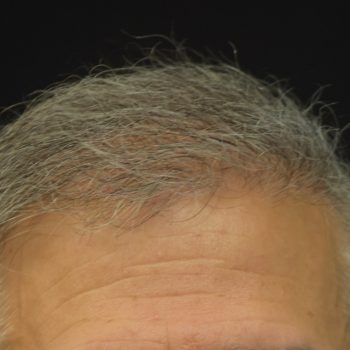 Fue Before and After | Dr. Jeffrey Wise