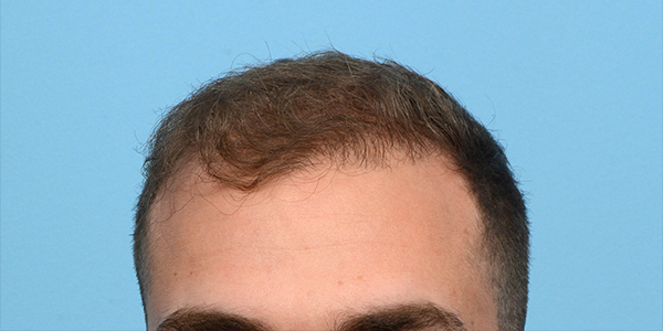 Fue Before and After | Dr. Jeffrey Wise