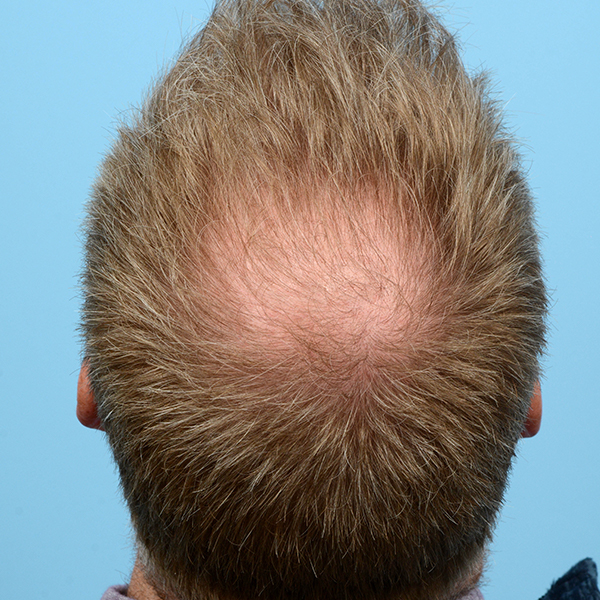 Fue Before and After | Dr. Jeffrey Wise