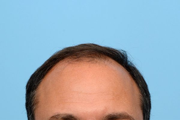 Fue Before and After | Dr. Jeffrey Wise