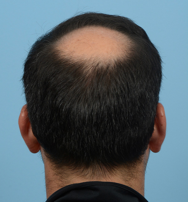 Fue Before and After | Dr. Jeffrey Wise