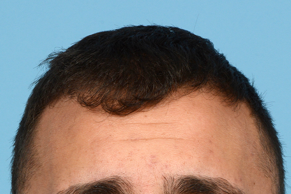 Fue Before and After | Dr. Jeffrey Wise