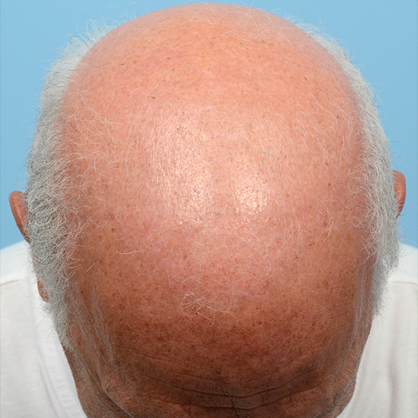 Fue Before and After | Dr. Jeffrey Wise