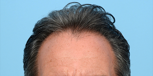 Fue Before and After | Dr. Jeffrey Wise