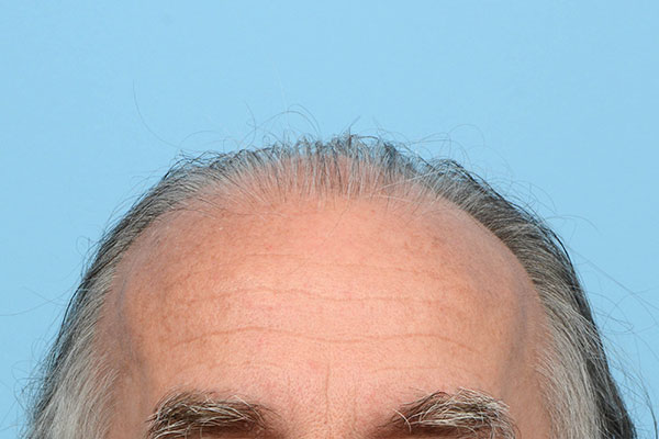 Fue Before and After | Dr. Jeffrey Wise