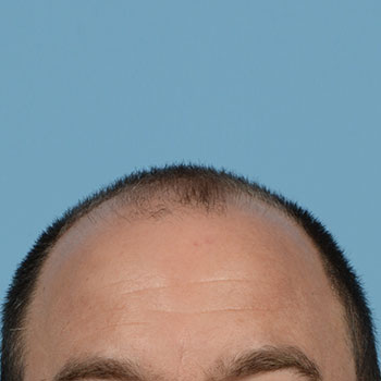 Fue Before and After | Dr. Jeffrey Wise