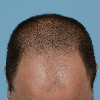 Fue Before and After | Dr. Jeffrey Wise