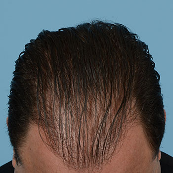 Fue Before and After | Dr. Jeffrey Wise