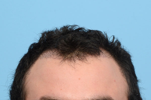 Fue Before and After | Dr. Jeffrey Wise