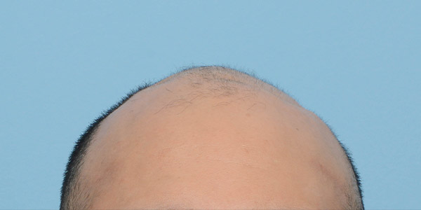 Fue Before and After | Dr. Jeffrey Wise