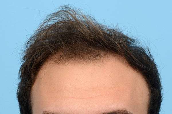 Fue Before and After | Dr. Jeffrey Wise