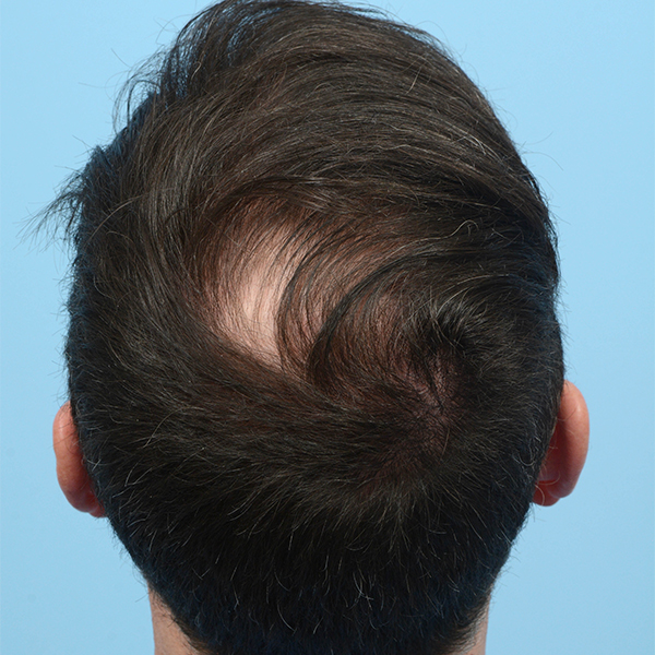 Fue Before and After | Dr. Jeffrey Wise