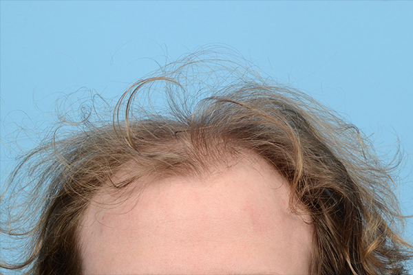 Fue Before and After | Dr. Jeffrey Wise