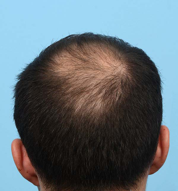 Fue Before and After | Dr. Jeffrey Wise