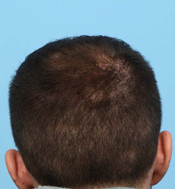 Fue Before and After | Dr. Jeffrey Wise