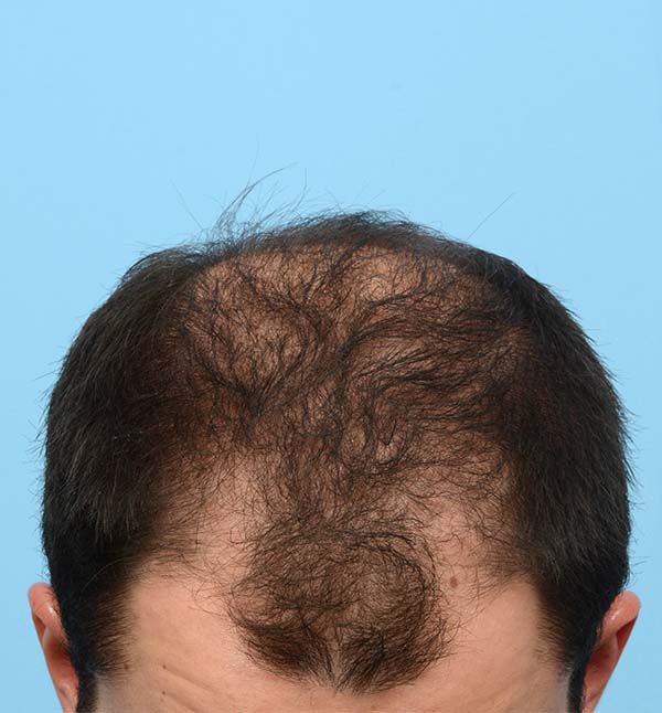 Fue Before and After | Dr. Jeffrey Wise