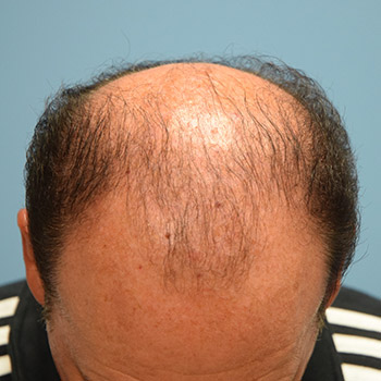 Fue Before and After | Dr. Jeffrey Wise