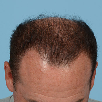 Fue Before and After | Dr. Jeffrey Wise